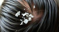 identify differentiate treat scalp