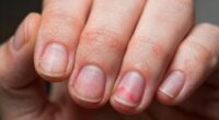 nail contact dermatitis warnings