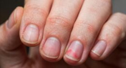 nail contact dermatitis warnings