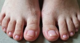 different care for toenails