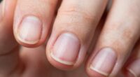 nail damage from cuticle biting