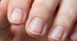 nail damage from cuticle biting