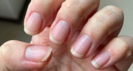 nail damage warning signs