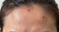 scalp tension and discomfort