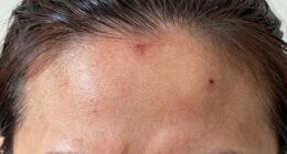 scalp tension and discomfort