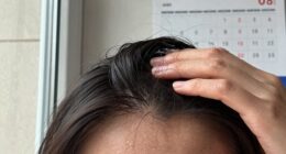seasonal hair shedding increase