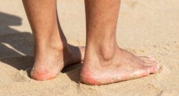 summer sandals reveal foot issues