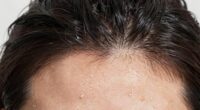 sweat accelerates scalp changes