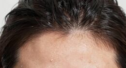 sweat accelerates scalp changes